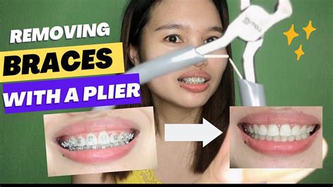 metal bracket remover|how to remove braces brackets.